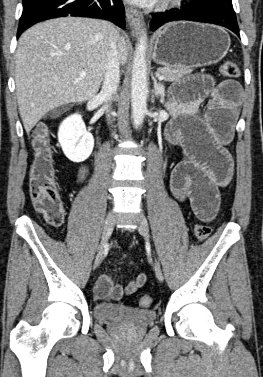 Adhesional small bowel obstruction (Radiopaedia 58900-66131 Coronal C+ portal venous phase 151).jpg