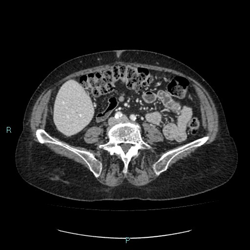 File:Adrenal collision tumor (ACT) (Radiopaedia 48462-53379 Axial C+ portal venous phase 37).jpg