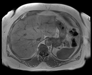 File:Adrenal cortical carcinoma (Radiopaedia 64017-72770 Axial T1 in-phase 12).jpg