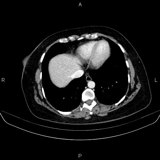 Adrenal cortical carcinoma (Radiopaedia 84882-100379 Axial C+ portal venous phase 7).jpg