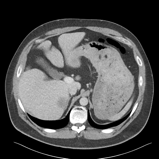 File:Adrenal cyst (Radiopaedia 45625-49777 Axial C+ portal venous phase 29).png