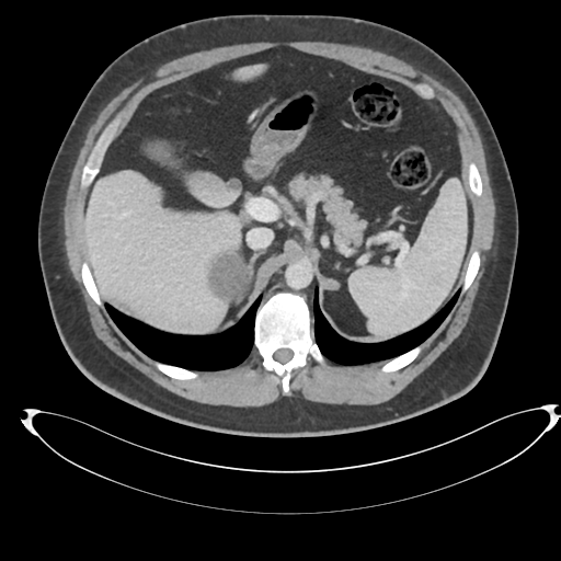 File:Adrenal cyst (Radiopaedia 45625-49778 AXIAL THICK 60 sec 15).png