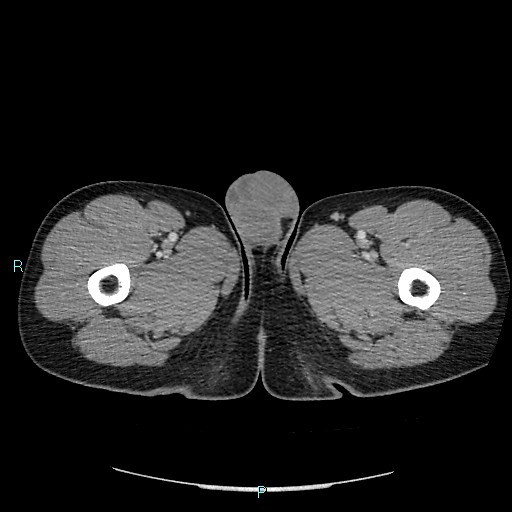 Adrenal cystic lymphangioma (Radiopaedia 83161-97534 Axial C+ portal venous phase 118).jpg