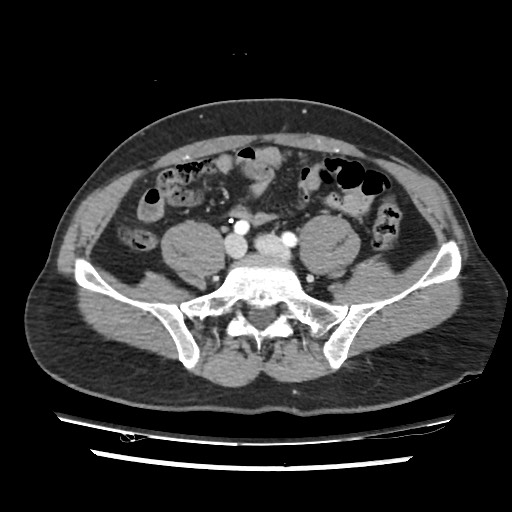 File:Adrenal gland trauma (Radiopaedia 81351-95078 Axial Dual bolus trauma C+ 96).jpg