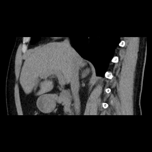 File:Adrenal gland trauma (Radiopaedia 81351-95079 Sagittal non-contrast 41).jpg