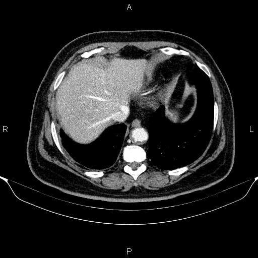 Adrenal hemorrhage (Radiopaedia 62622-70916 Axial C+ portal venous phase 15).jpg