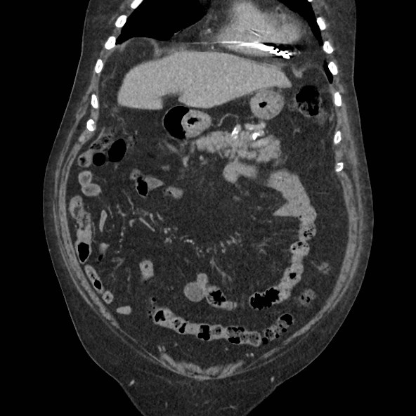 Adrenal lymphoma (Radiopaedia 84145-99415 Coronal C+ portal venous phase 23).jpg