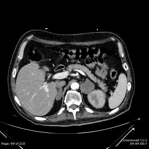 Adrenal metastasis (Radiopaedia 78425-91079 Axial C+ arterial phase 29).jpg