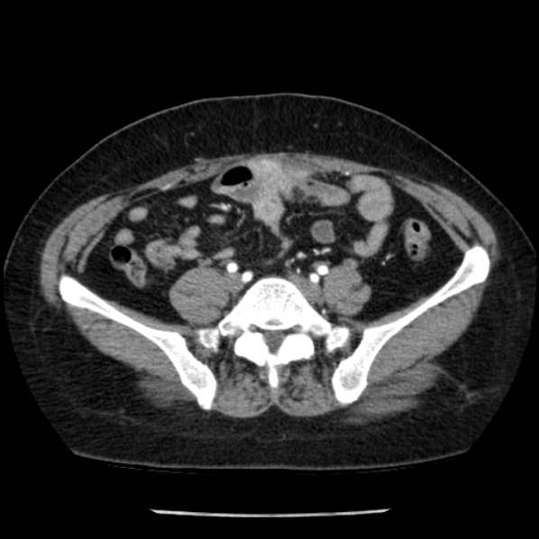 Adrenal myelolipoma (Radiopaedia 43401-46759 Axial C+ arterial phase 74).jpg