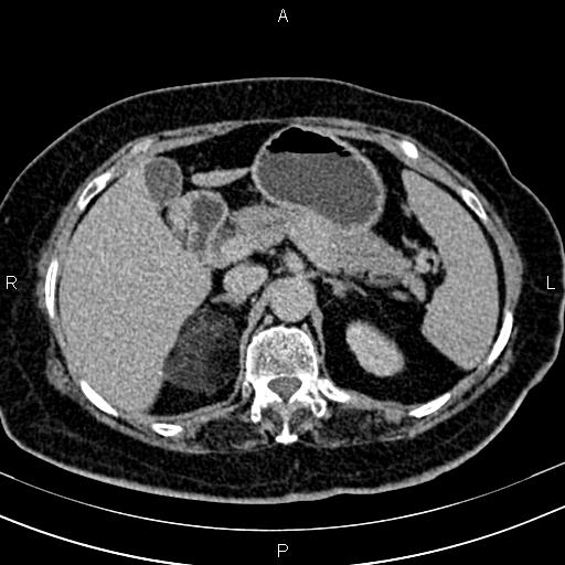 Adrenal myelolipoma (Radiopaedia 82742-96986 Axial renal excretory phase 38).jpg
