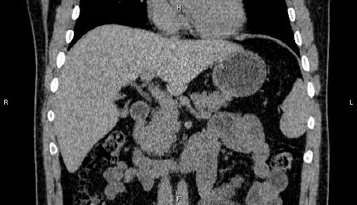 Adrenal myelolipoma (Radiopaedia 84321-99619 Coronal non-contrast 35).jpg
