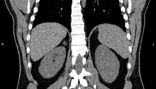 File:Adrenal myelolipoma (Radiopaedia 84321-99619 Coronal non-contrast 59).jpg