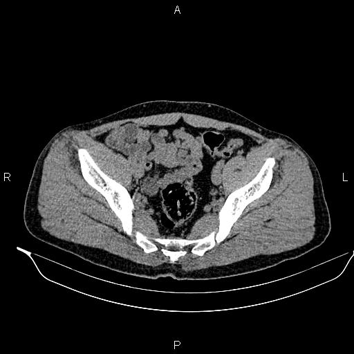 Adrenal myelolipoma (Radiopaedia 87794-104246 Axial non-contrast 89).jpg