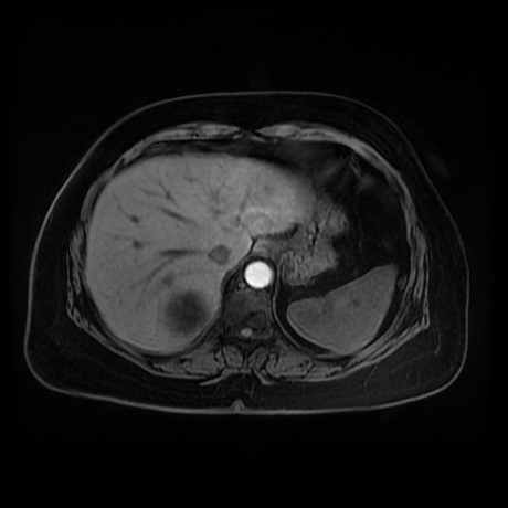 Adrenal myelolipoma - MRI (Radiopaedia 83249-97646 Axial T1 fat sat 9).jpg