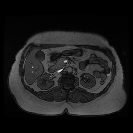 File:Adrenal myelolipoma - MRI (Radiopaedia 83249-97646 T1 out-of-phase 14).jpg