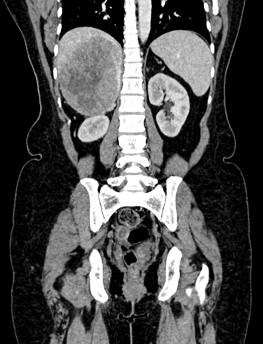 Adrenocortical carcinoma (Radiopaedia 87281-103569 Coronal C+ portal venous phase 89).jpg
