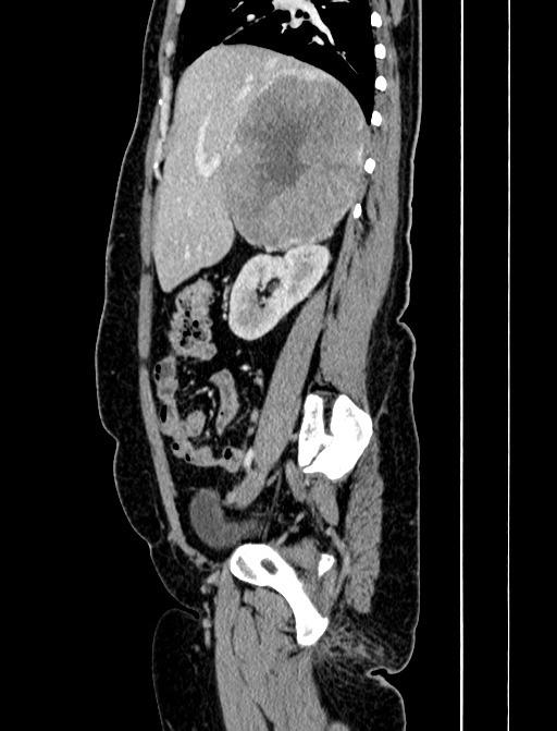 Adrenocortical carcinoma (Radiopaedia 87281-103569 Sagittal C+ portal venous phase 92).jpg