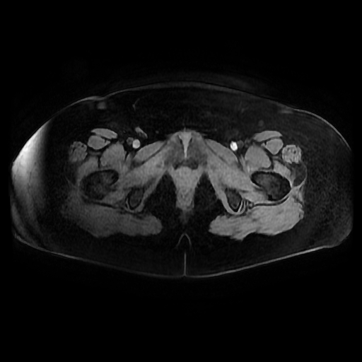 File:Adult granulosa cell tumor of the ovary (Radiopaedia 64991-73953 axial-T1 Fat sat post-contrast dynamic 8).jpg