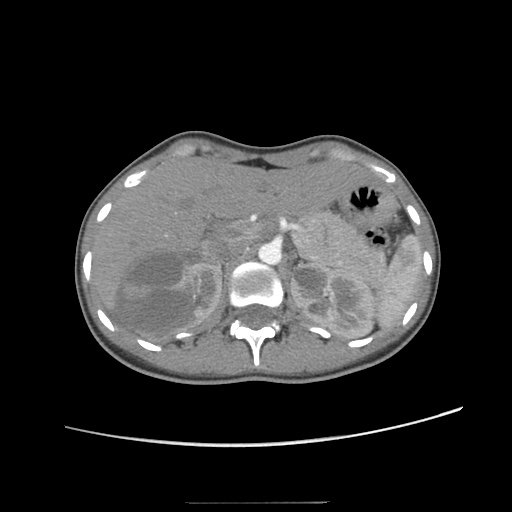 Adult polycystic kidney disease (Radiopaedia 48845-53876 Axial renal cortical phase 14).jpg
