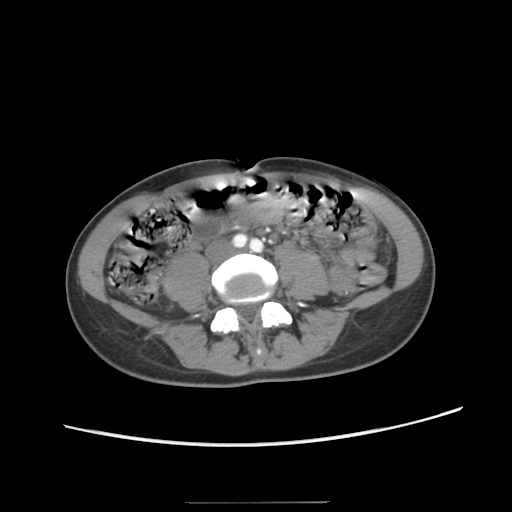 Adult polycystic kidney disease (Radiopaedia 48845-53876 Axial renal cortical phase 46).jpg