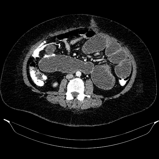 Afferent loop syndrome - secondary to incarcerated trocar site hernia (Radiopaedia 82959-97305 Axial C+ portal venous phase 126).jpg
