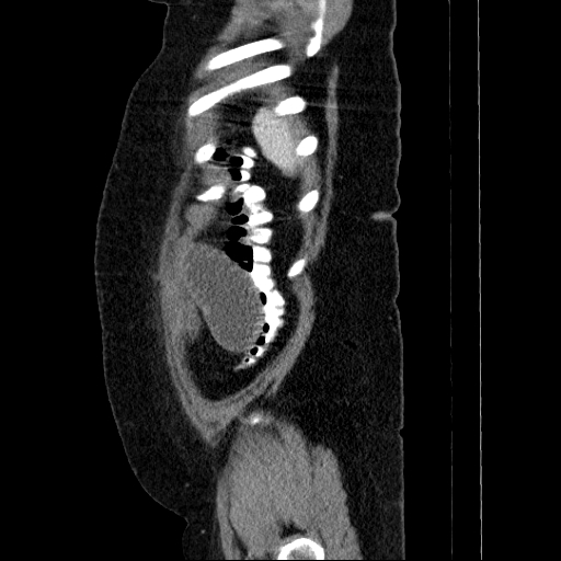 File:Afferent loop syndrome - secondary to incarcerated trocar site hernia (Radiopaedia 82959-97305 Sagittal C+ portal venous phase 14).jpg