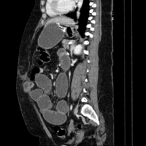 Afferent loop syndrome - secondary to incarcerated trocar site hernia (Radiopaedia 82959-97305 Sagittal C+ portal venous phase 63).jpg