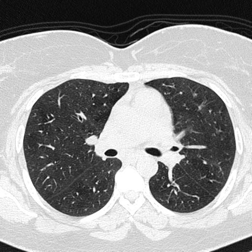 Air trapping in small airway disease (Radiopaedia 61685-69694 Axial lung window 76).jpg