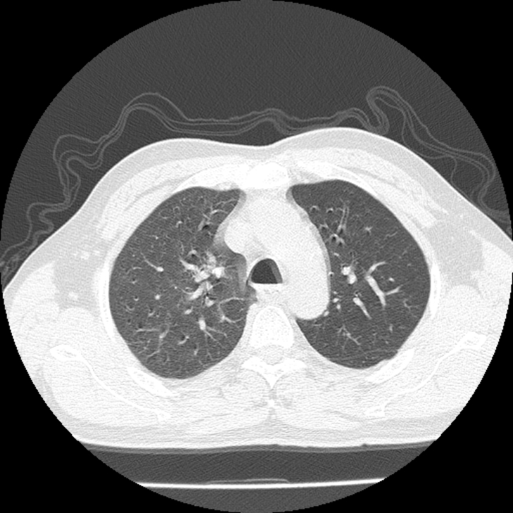 Airway foreign body in adult (Radiopaedia 85907-101779 Axial lung window 39).jpg