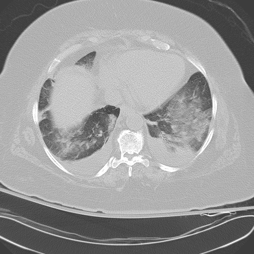All trans retinoic acid (ATRA) syndrome (Radiopaedia 38212-40229 Axial lung window 40).jpg