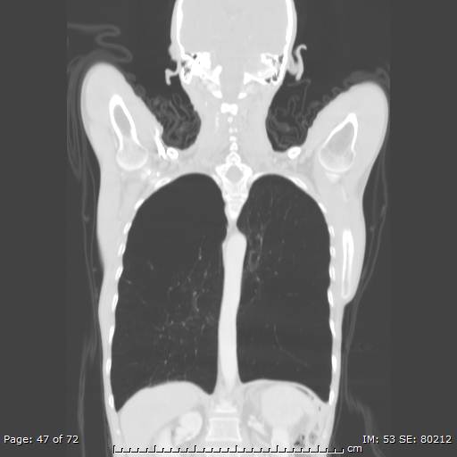 Alpha-1-antitrypsin deficiency (Radiopaedia 50561-55987 Coronal lung window 45).jpg