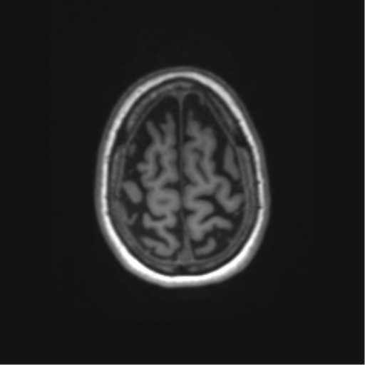 File:Alzheimer's disease (Radiopaedia 42658-45802 Axial T1 28).png