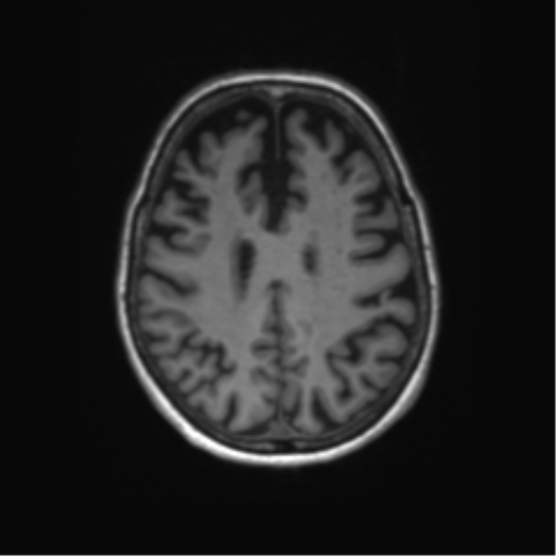 File:Alzheimer's disease (Radiopaedia 42658-45802 Axial T1 53).png