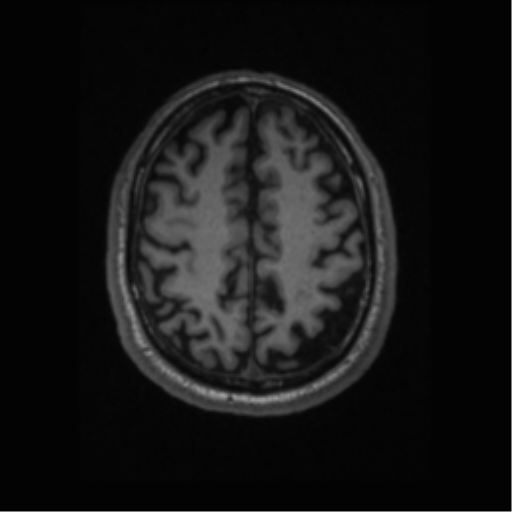 Alzheimer disease - probable (Radiopaedia 35334-36837 Axial T1 56).png