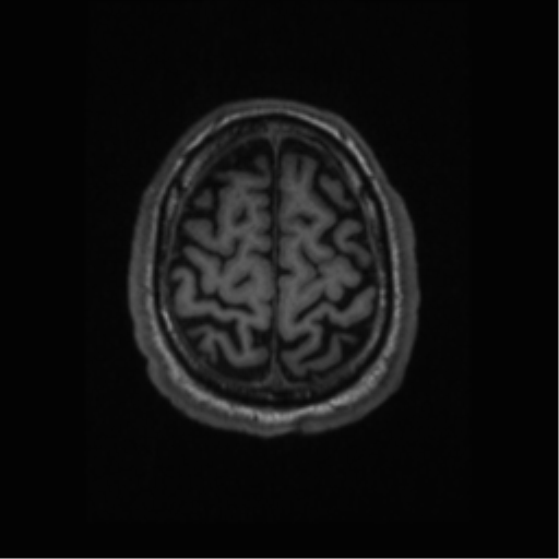 Alzheimer disease - probable (Radiopaedia 35334-36837 Axial T1 63).png