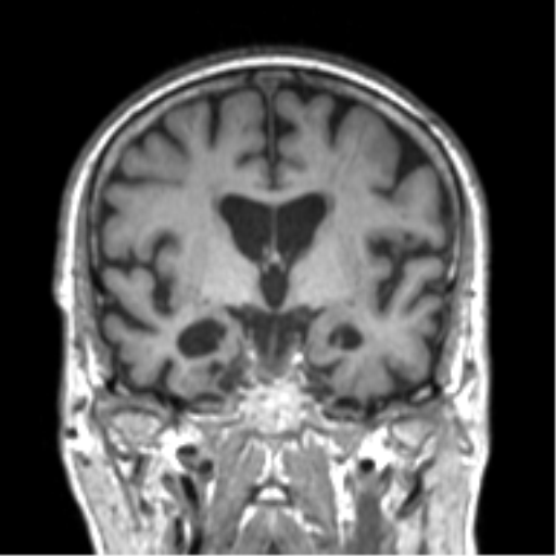 Alzheimer disease and cerebral amyloid angiopathy (Radiopaedia 64234-73011 Coronal T1 36).png
