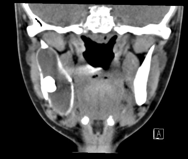 File:Ameloblastoma (Radiopaedia 26645-26793 Coronal C+ delayed 10).jpg