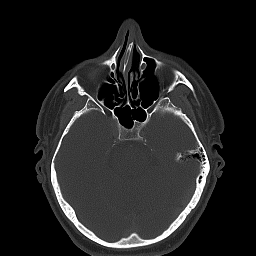 File:Ameloblastoma (Radiopaedia 38520-40623 Axial bone window 8).png
