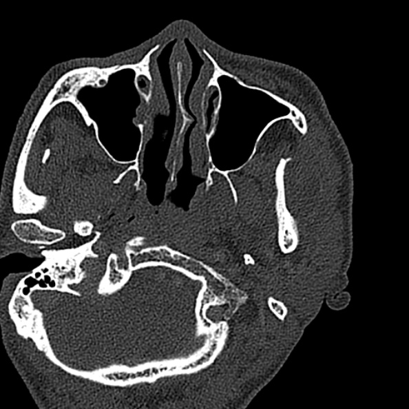 Ameloblastoma (Radiopaedia 51921-57766 Axial bone window 135).jpg