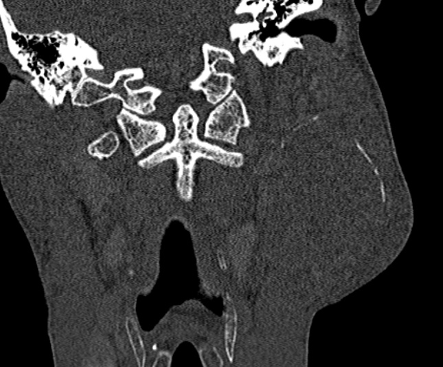 Ameloblastoma (Radiopaedia 51921-57766 Coronal bone window 212).jpg