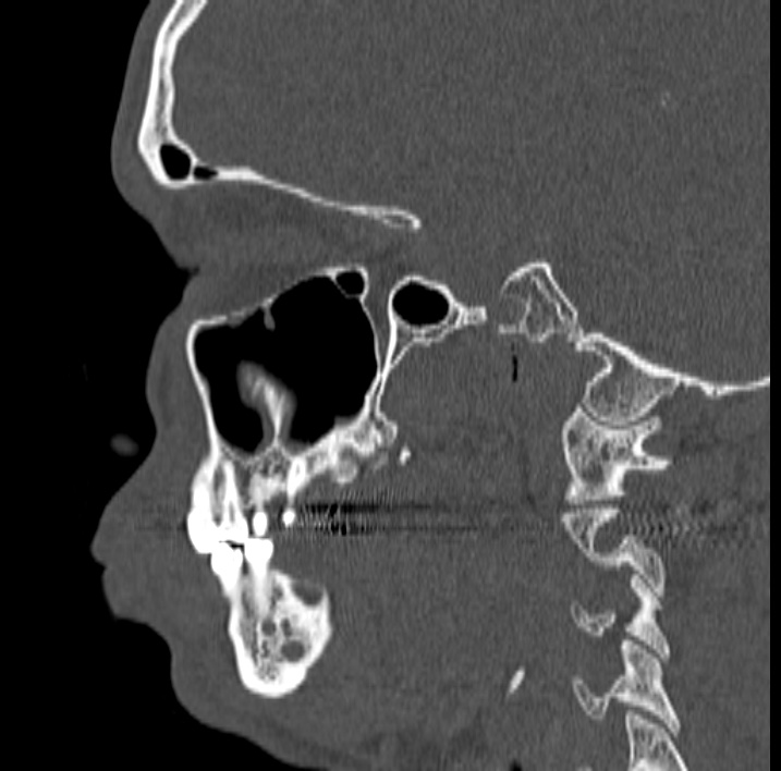 Ameloblastoma (Radiopaedia 77750-89997 Sagittal bone window 24).jpg