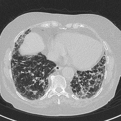 File:Amiodarone-induced pulmonary fibrosis (Radiopaedia 82355-96460 Axial lung window 50).jpg