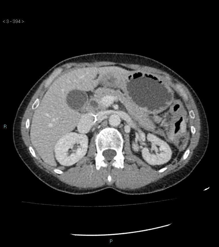 Ampulla of Vater metastasis (Radiopaedia 27820-28069 A 32).jpg