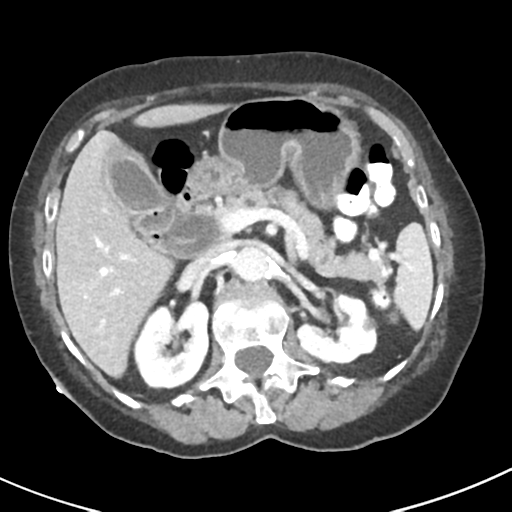 Ampullary adenocarcinoma (Radiopaedia 34013-35237 C 15).png