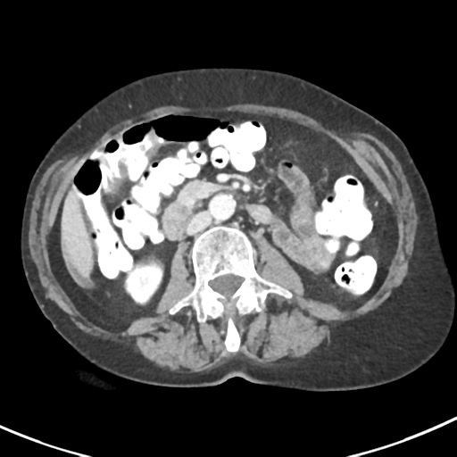 Ampullary adenocarcinoma (Radiopaedia 34013-35237 C 24).png
