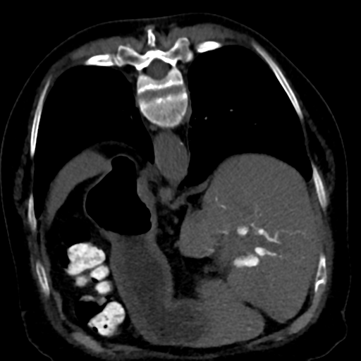 Ampullary adenocarcinoma (Radiopaedia 34013-35241 C 25).png