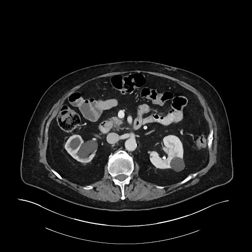 Ampullary adenocarcinoma (Radiopaedia 59373-66734 C 65).jpg