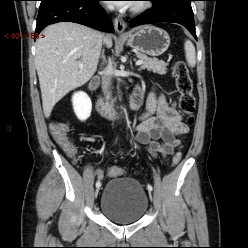 Ampullary carcinoma (Radiopaedia 56396-63056 E 52).jpg