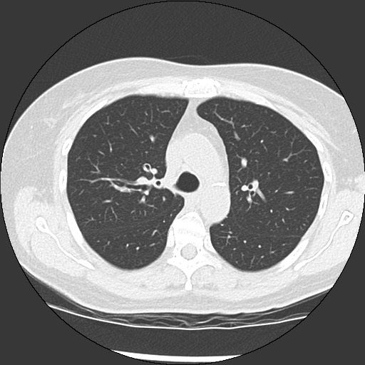 Amyloidosis - bronchial and diffuse nodular pulmonary involvement (Radiopaedia 60156-67744 B 20).jpg