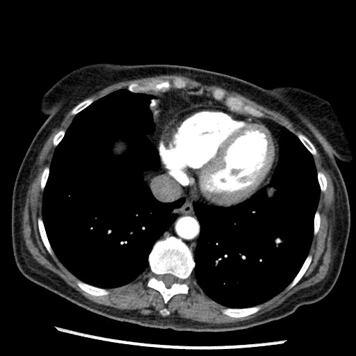 Amyloidosis - bronchial and diffuse nodular pulmonary involvement (Radiopaedia 60156-67745 A 40).jpg
